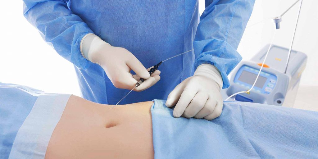 Laser Körperstraffung nach Liposuktion München PANTEA